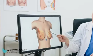لیفت سینه (ماستوپکسی) چیست و چه زمانی باید انجام شود؟