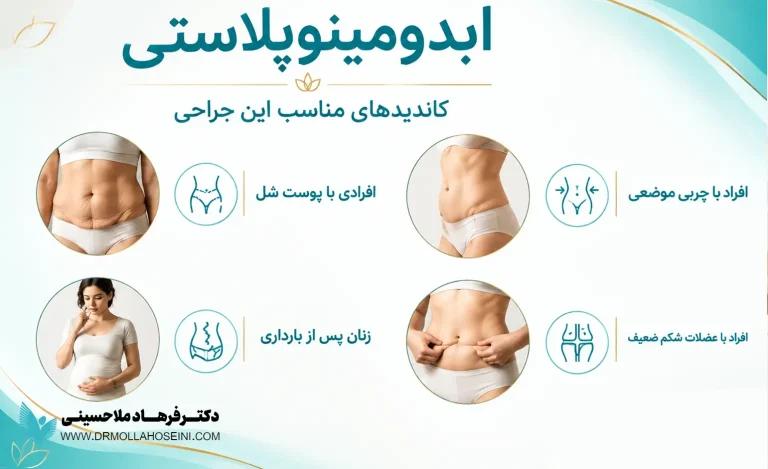کاندیداهای ابدومینوپلاستی | دکتر فرهاد ملاحسینی
