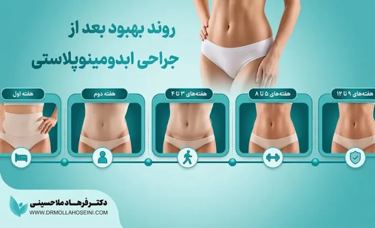 دوران نقاهت و مراقبت‌های بعد از عمل ابدومینوپلاستی