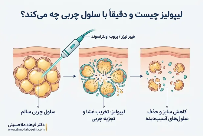 لیپولیز | دکتر ملاحسینی