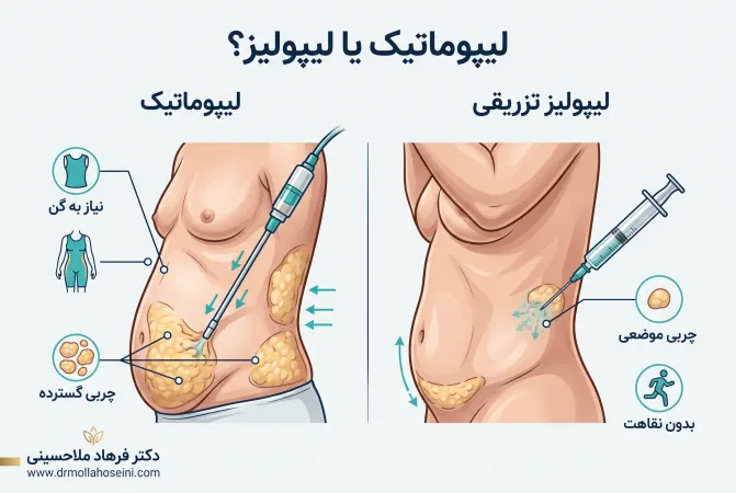 لیپوماتیک یا لیپولیز | dr farhad mollahoseini