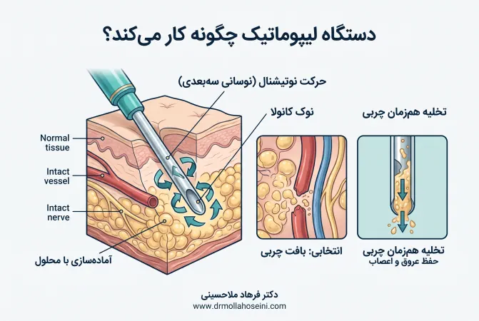 دستگاه لیپوماتیک | دکتر فرهاد ملاحسینی