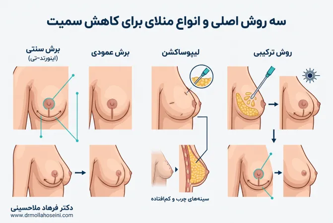 روشهای برش در کوچک کردن سینه | دکتر فرهاد ملاحسینی