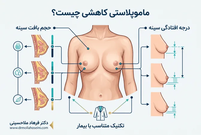 ماموپلاستی کاهشی | دکتر فرهاد ملاحسینی