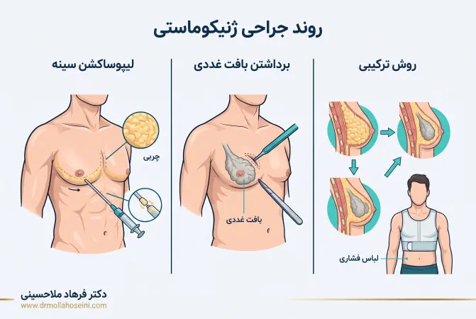 روند جراحی ژنیکوماستی | دکتر فرهاد ملاحسینی