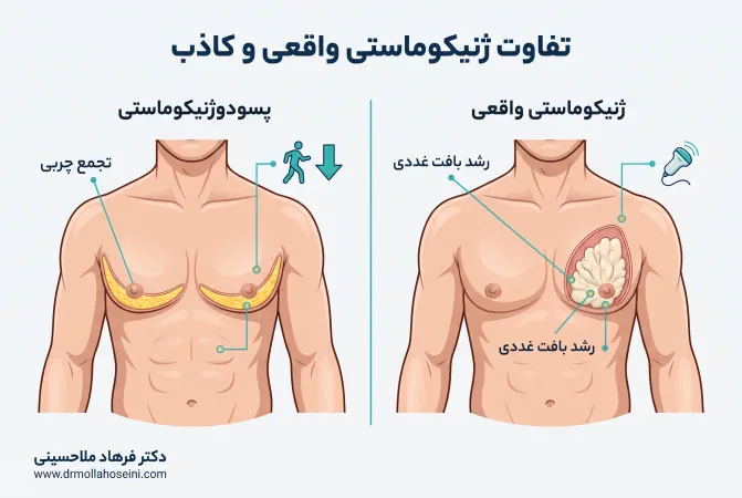 تفاوت ژنیکوماستی واقعی با پسودوژنیکوماستی